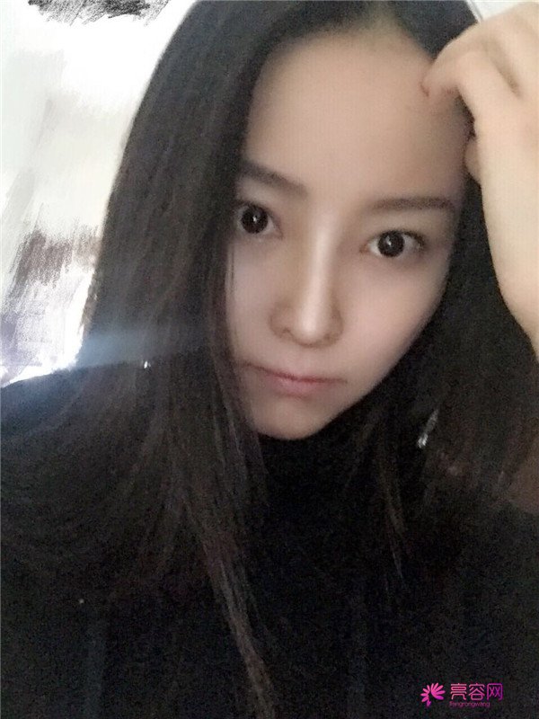 我来和大家分享我的隆鼻日记了,我自己恢复得不错,所以放心大胆的将自己的鼻子交给医院啦~