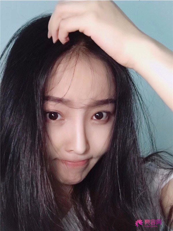 我来和大家分享我的隆鼻日记了,我自己恢复得不错,所以放心大胆的将自己的鼻子交给医院啦~
