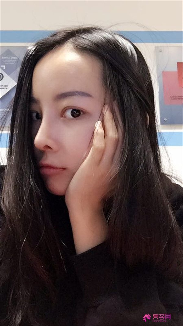 我来和大家分享我的隆鼻日记了,我自己恢复得不错,所以放心大胆的将自己的鼻子交给医院啦~