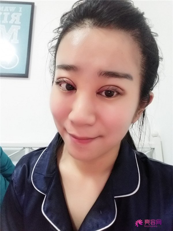 【分享案例】给宝宝们分享我的双眼皮之路啦!宝宝们我做双眼皮是打的局麻,其实局麻一点都不痛