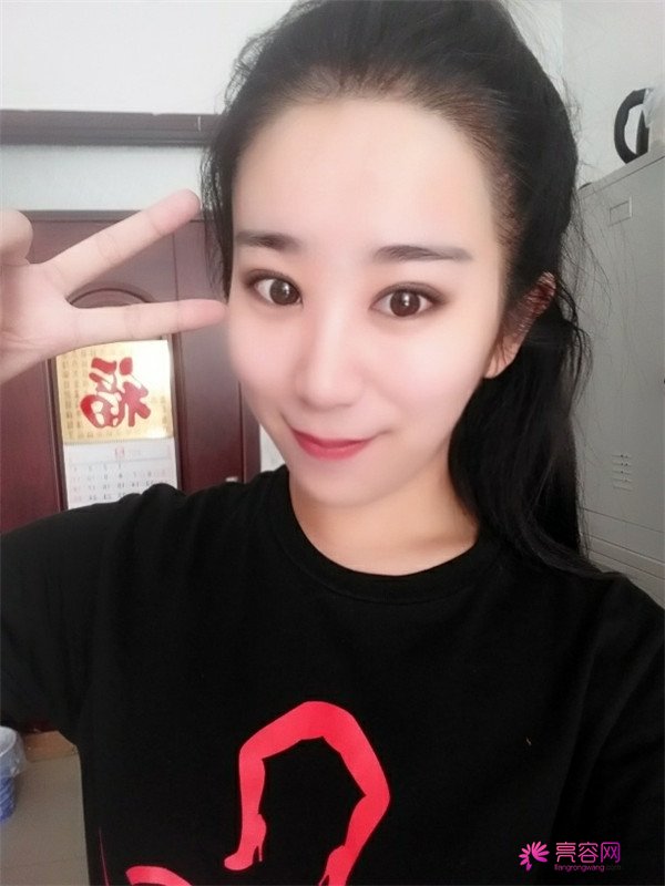【分享案例】给宝宝们分享我的双眼皮之路啦!宝宝们我做双眼皮是打的局麻,其实局麻一点都不痛