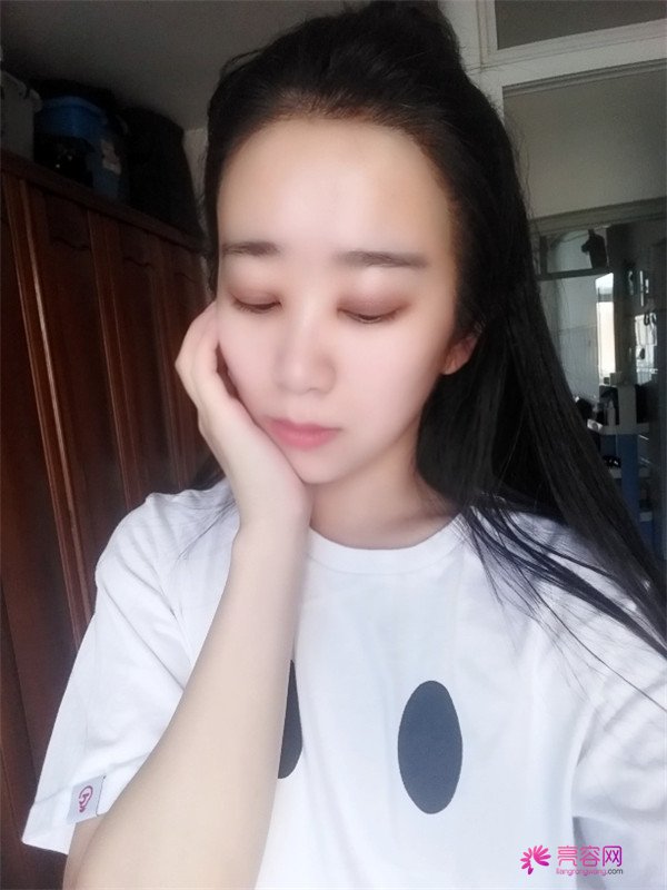 【分享案例】给宝宝们分享我的双眼皮之路啦!宝宝们我做双眼皮是打的局麻,其实局麻一点都不痛