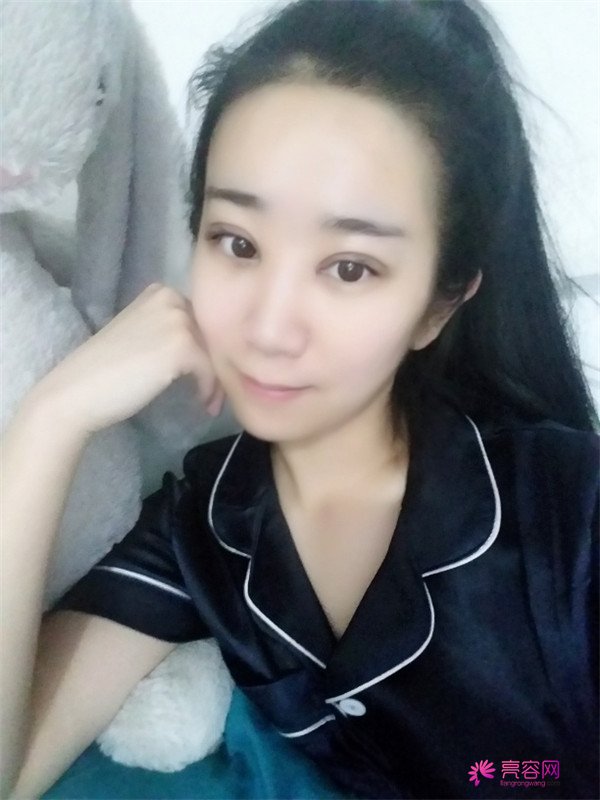 【分享案例】给宝宝们分享我的双眼皮之路啦!宝宝们我做双眼皮是打的局麻,其实局麻一点都不痛