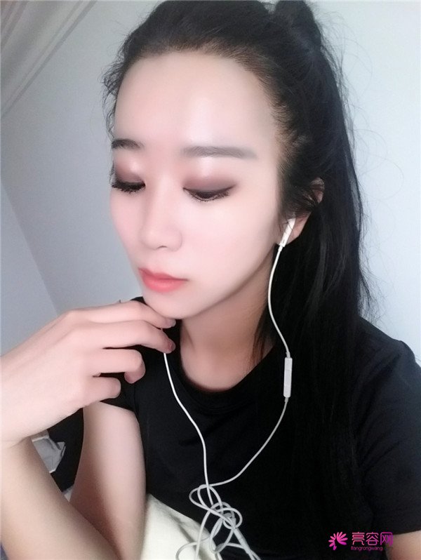 【分享案例】给宝宝们分享我的双眼皮之路啦!宝宝们我做双眼皮是打的局麻,其实局麻一点都不痛