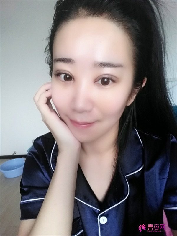【分享案例】给宝宝们分享我的双眼皮之路啦!宝宝们我做双眼皮是打的局麻,其实局麻一点都不痛