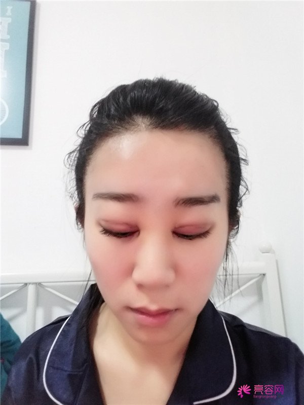 【分享案例】给宝宝们分享我的双眼皮之路啦!宝宝们我做双眼皮是打的局麻,其实局麻一点都不痛