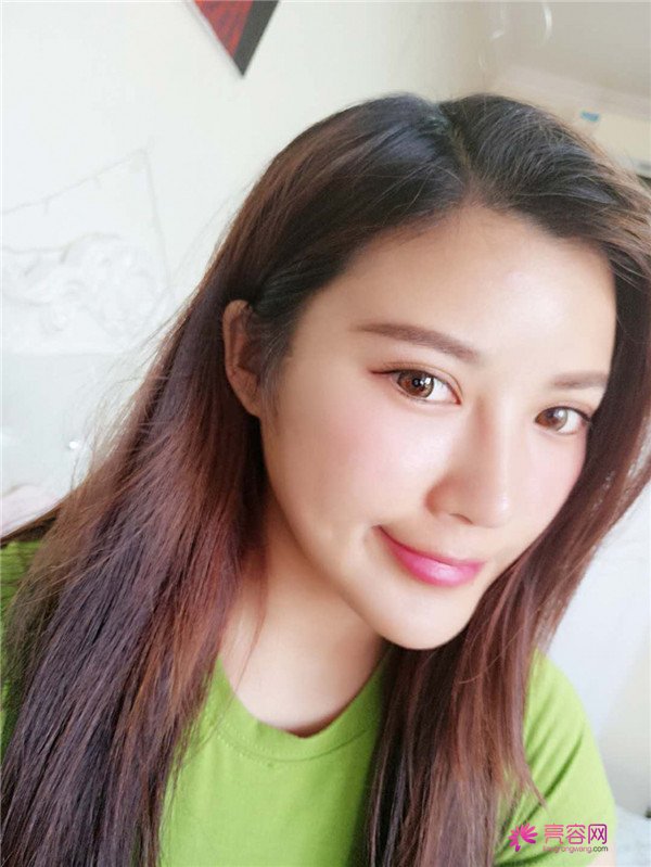 姐妹们,越是年轻越要保养!来看看我的埋线提升案例吧, 自己年轻了快10岁了
