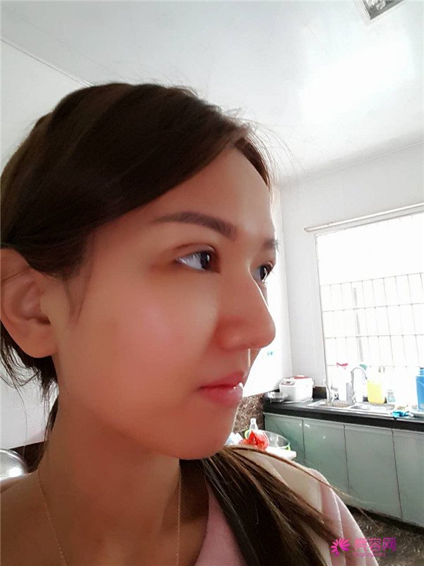 【全切+祛皮祛脂】分享我的术后恢复小妙招!宝宝们刚做完手术的前几天因为眼睛肿胀的厉害会比较丑