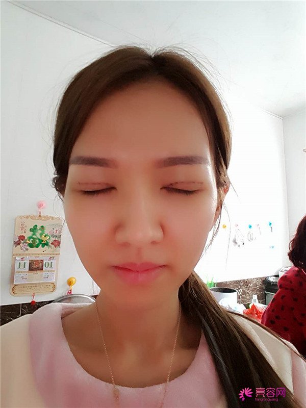 【全切+祛皮祛脂】分享我的术后恢复小妙招!宝宝们刚做完手术的前几天因为眼睛肿胀的厉害会比较丑