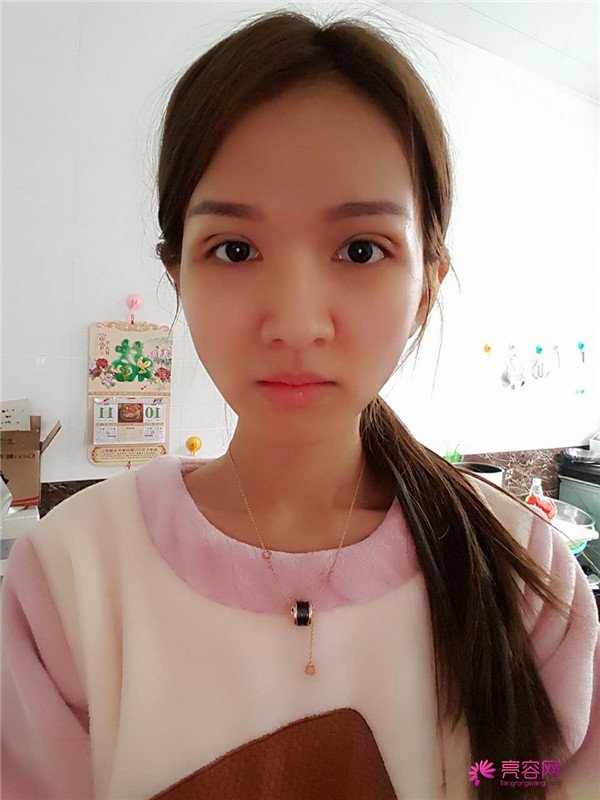 【全切+祛皮祛脂】分享我的术后恢复小妙招!宝宝们刚做完手术的前几天因为眼睛肿胀的厉害会比较丑