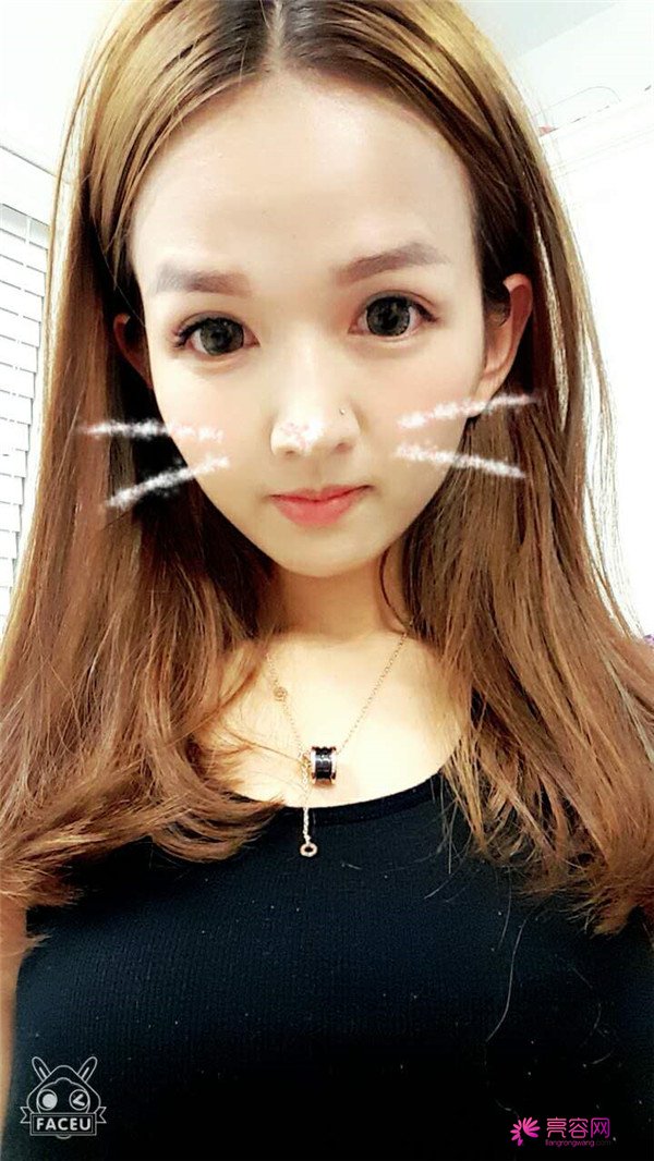 【全切+祛皮祛脂】分享我的术后恢复小妙招!宝宝们刚做完手术的前几天因为眼睛肿胀的厉害会比较丑