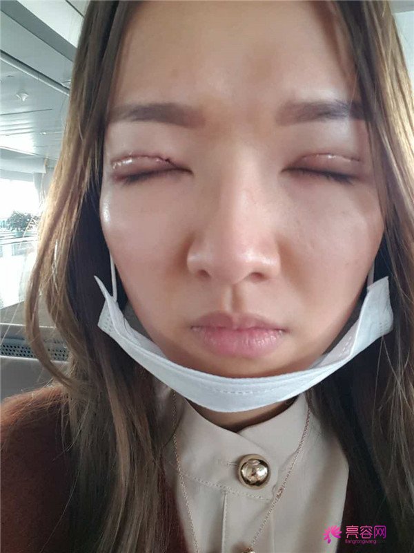 【全切+祛皮祛脂】分享我的术后恢复小妙招!宝宝们刚做完手术的前几天因为眼睛肿胀的厉害会比较丑