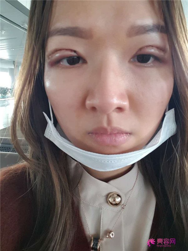 【全切+祛皮祛脂】分享我的术后恢复小妙招!宝宝们刚做完手术的前几天因为眼睛肿胀的厉害会比较丑