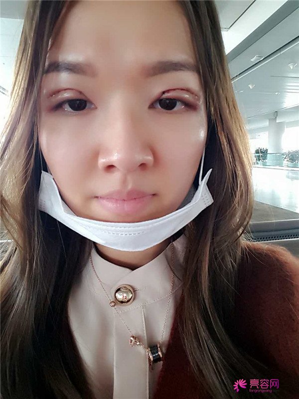 【全切+祛皮祛脂】分享我的术后恢复小妙招!宝宝们刚做完手术的前几天因为眼睛肿胀的厉害会比较丑