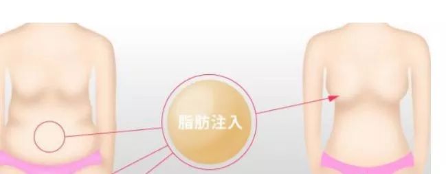 自体脂肪隆胸,手感和外观都是真实吗?