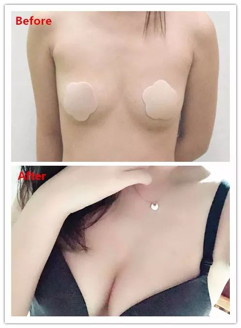 自体脂肪隆胸,手感和外观都是真实吗?
