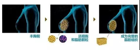 自体脂肪丰胸能不能看出来?