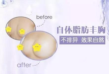 自体脂肪丰胸能不能看出来?