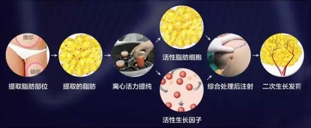 自体脂肪丰胸能不能看出来?