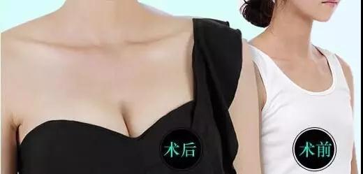 自体脂肪丰胸能不能看出来?