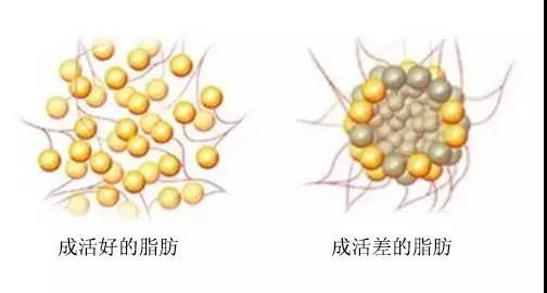 自体脂肪丰胸能不能看出来?