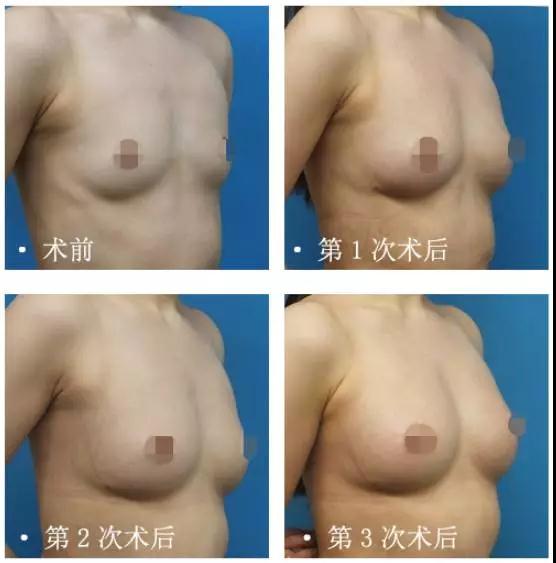 自体脂肪丰胸能不能看出来?