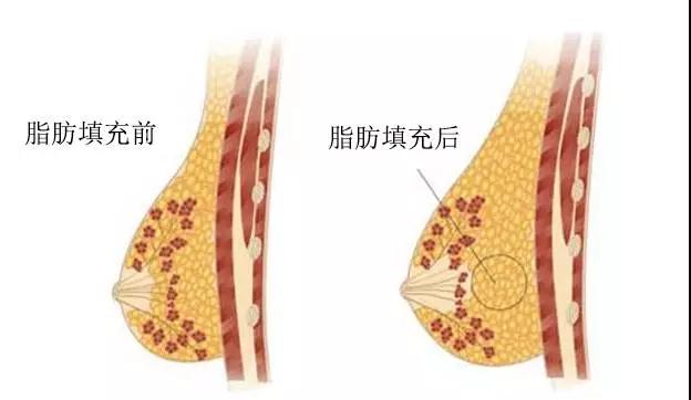 自体脂肪丰胸能不能看出来?