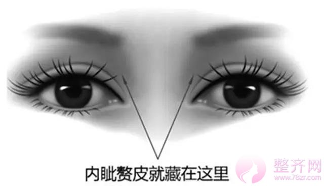 为什么有些人做双眼皮的同时要开眼角?
