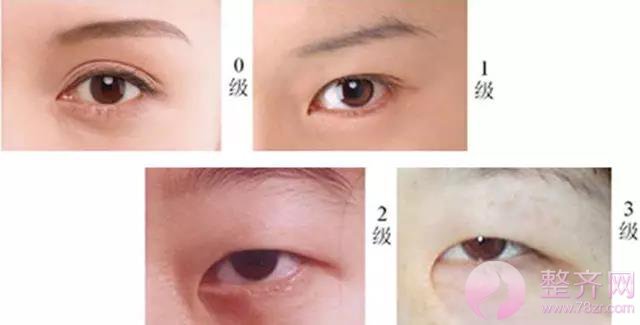 为什么有些人做双眼皮的同时要开眼角?