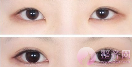 为什么有些人做双眼皮的同时要开眼角?