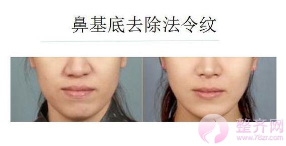 如果你的鼻基底有问题,那么千万别急着隆鼻!