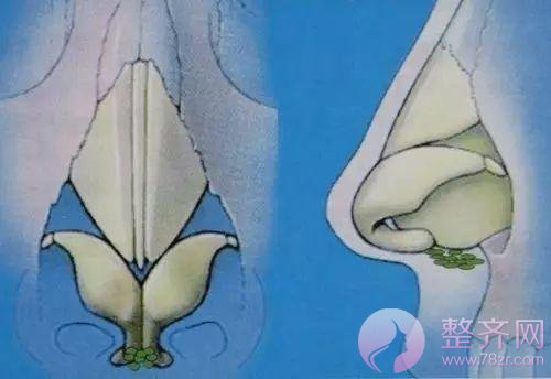 如果你的鼻基底有问题,那么千万别急着隆鼻!