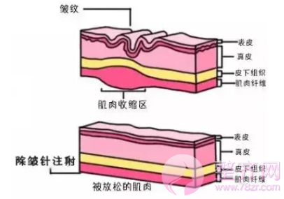 如何快速有的除去皱纹?