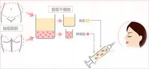 你知道吗?自体脂肪填充能让脸看起来更瘦!