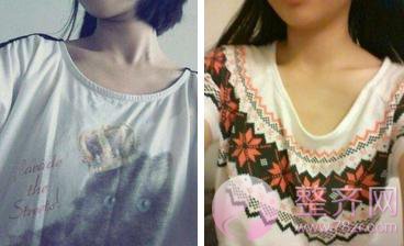 哺乳过后,胸部萎缩不到A,严重下垂,怎么破?