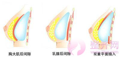 哺乳过后,胸部萎缩不到A,严重下垂,怎么破?
