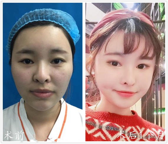 自体脂肪填充,润色出如玉般精致脸庞