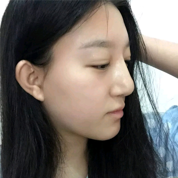 小仙女儿的鼻部手术案例分享连载(二)