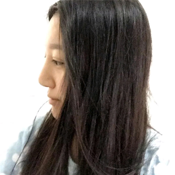 小仙女儿的鼻部手术案例分享连载(二)