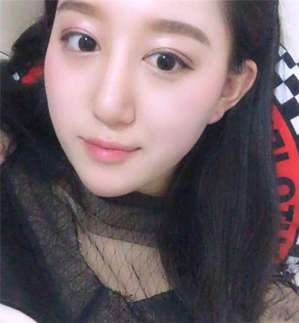 小仙女儿的鼻部手术案例分享连载(二)