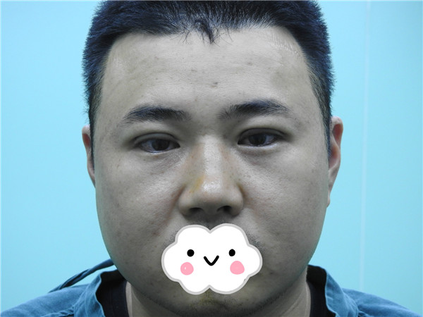 油腻老鲜肉也有春天之双眼皮大改造案例连载(一)