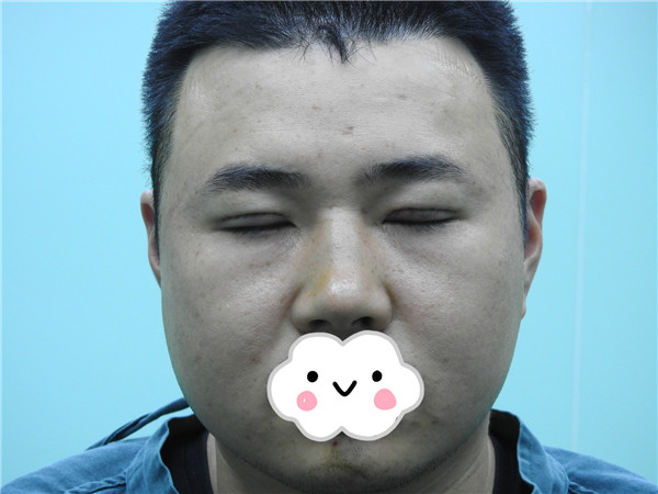 油腻老鲜肉也有春天之双眼皮大改造案例连载(一)