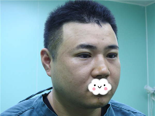 油腻老鲜肉也有春天之双眼皮大改造案例连载(一)