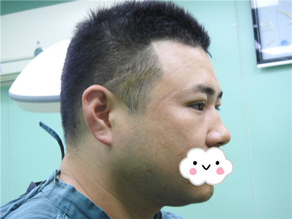 油腻老鲜肉也有春天之双眼皮大改造案例连载(一)