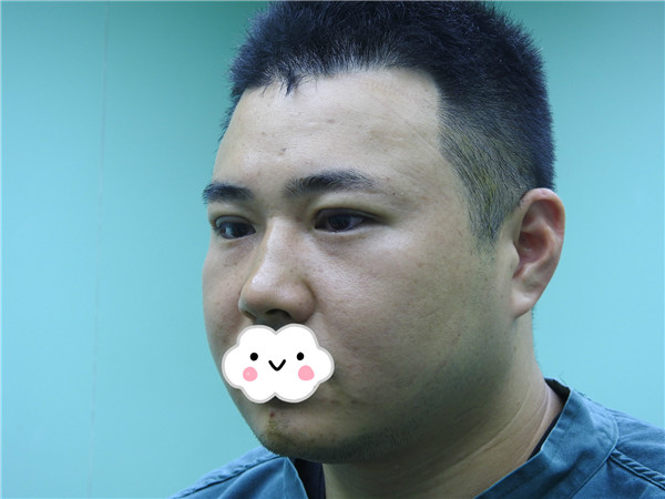 油腻老鲜肉也有春天之双眼皮大改造案例连载(一)