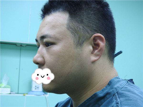 油腻老鲜肉也有春天之双眼皮大改造案例连载(一)