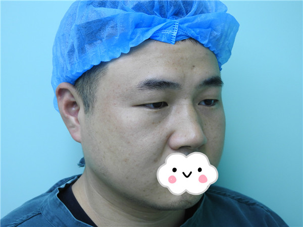 油腻老鲜肉也有春天之双眼皮大改造案例连载(一)