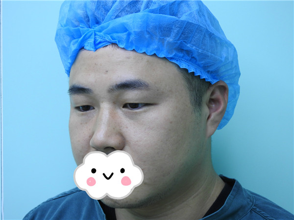 油腻老鲜肉也有春天之双眼皮大改造案例连载(一)