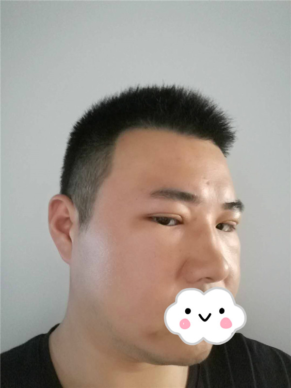 油腻老鲜肉也有春天之双眼皮大改造案例连载(二)