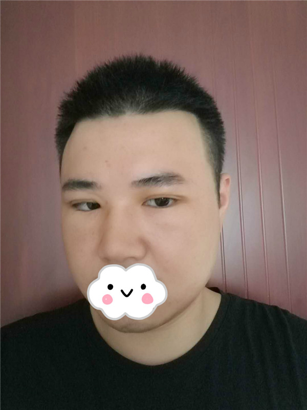 油腻老鲜肉也有春天之双眼皮大改造案例连载(二)